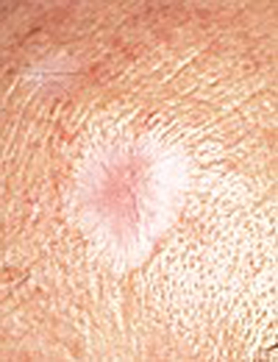 Types of Skin Cancer - Miami Beach Skincenter Dermatologists Miami